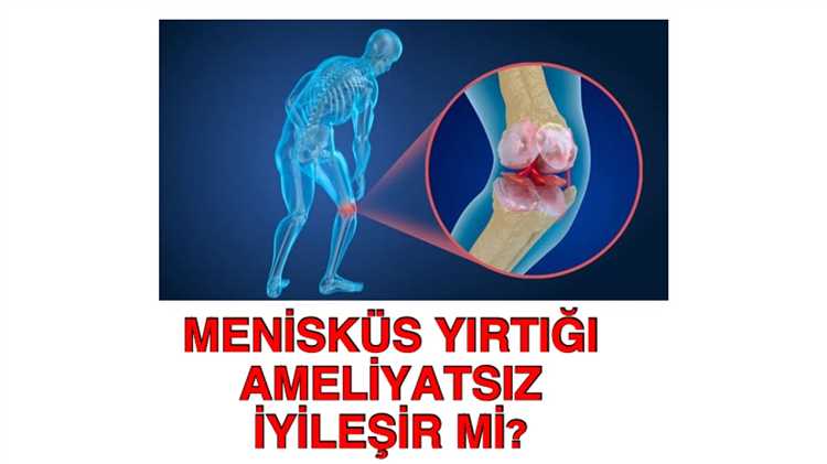 Ameliyatsız diz menisküs yırtığı tedavisi