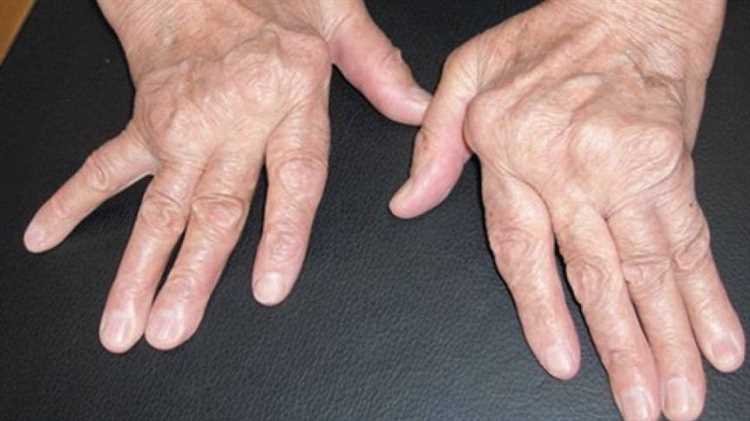 Artrit ve Artroz: Belirtileri, Nedenleri ve Tedavisi