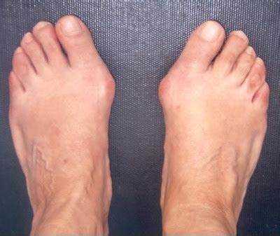 Ayak başparmağının valgus deformitesi