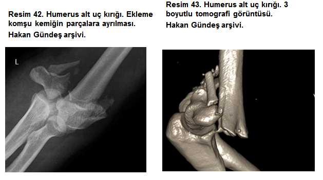 Lokaldir Kırığının Nedenleri