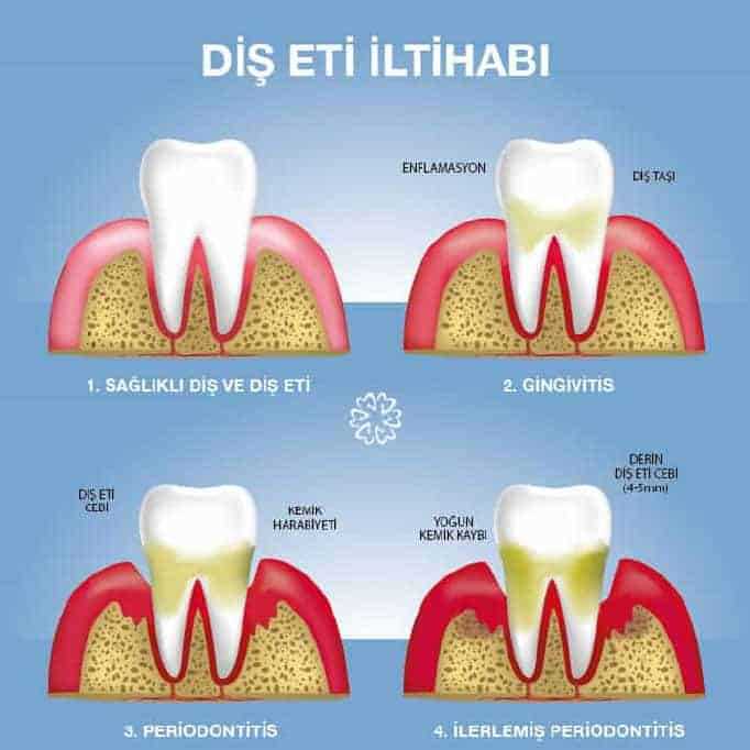 Diz Eklemi İltihabı: Nedenleri, Belirtileri ve Tedavisi