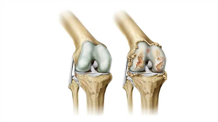 Eklem Osteoartriti: Müşteri Yorumları ve Sınıflandırma