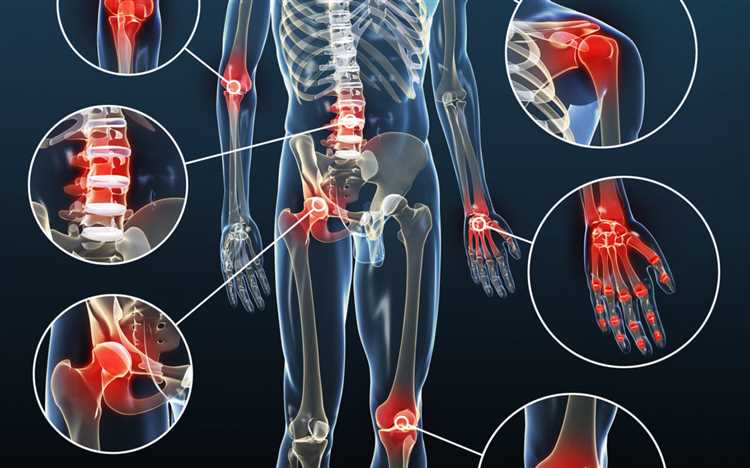 Eklem Osteoartriti Nedir? - Eklem Osteoartriti Hakkında Bilgi