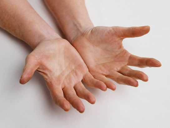 El parmak çıkığı: Nedenleri, belirtileri ve tedavisi
