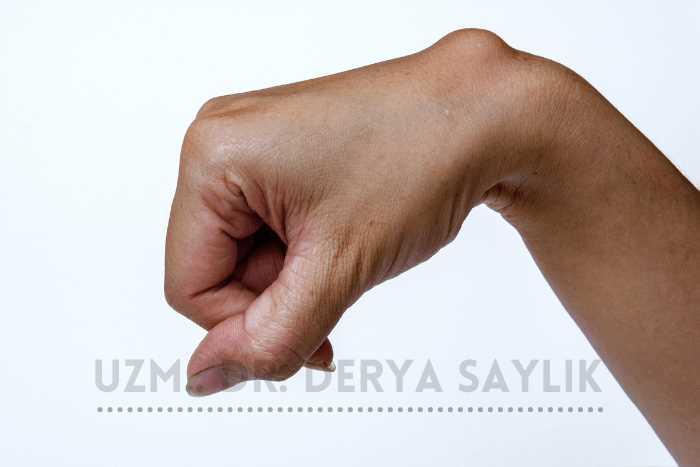 Elinizin bileği üzerindeki ganglion kistleri hakkında bilgi
