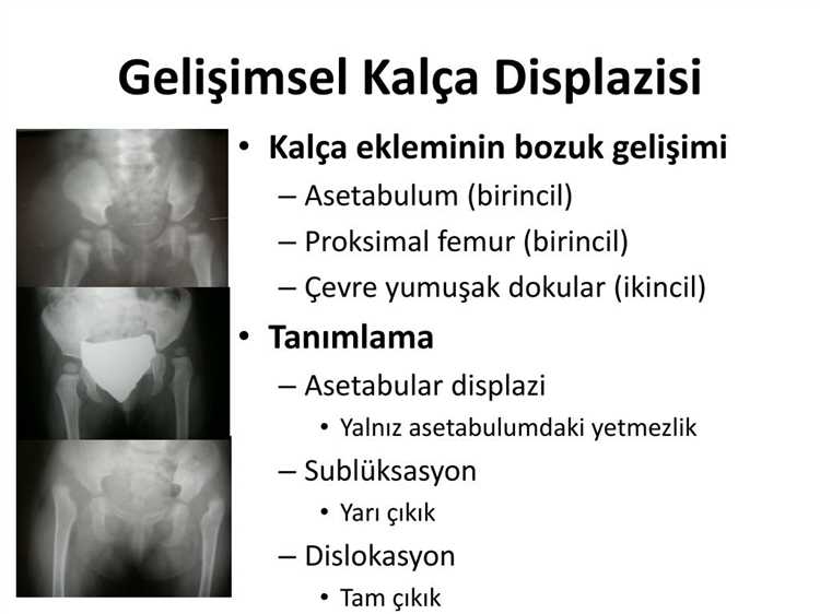 Kalça displazisi - Belirtiler, nedenler ve tedavi yöntemleri