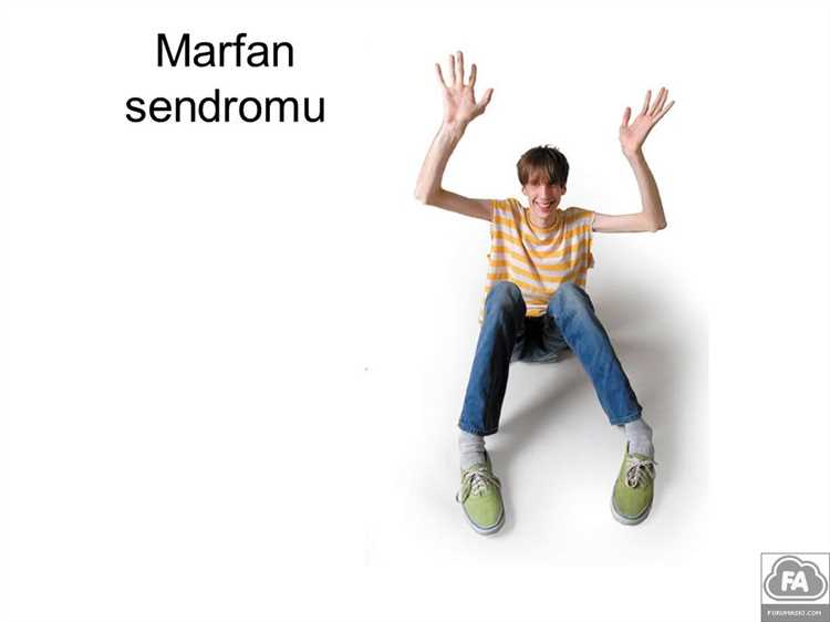 Marfan Sendromu Nedir? Belirtileri, Teşhisi ve Tedavisi