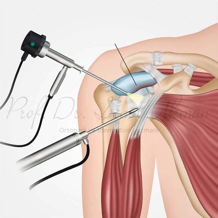 Omuz Artroskopisi: Teknolojinin Gücüyle Tanı ve Tedavi
