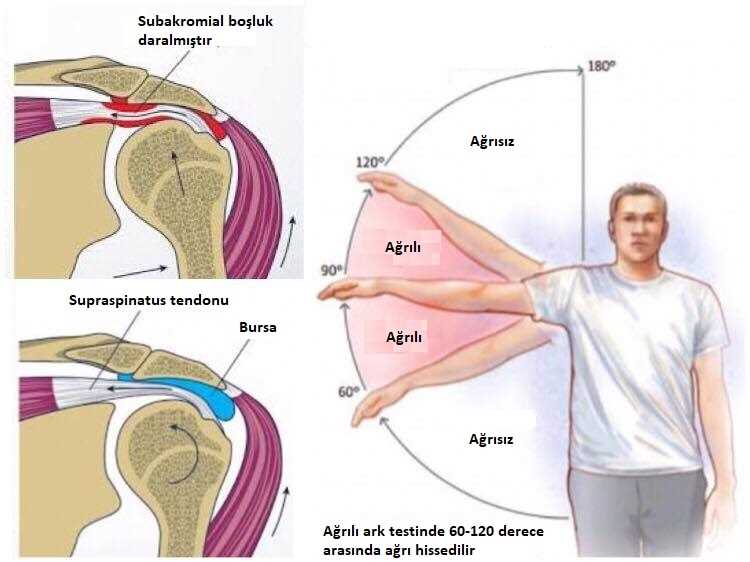 Omuz Eklemi İmpingement Sendromu Nedir? Belirtileri ve Tedavi Yöntemleri