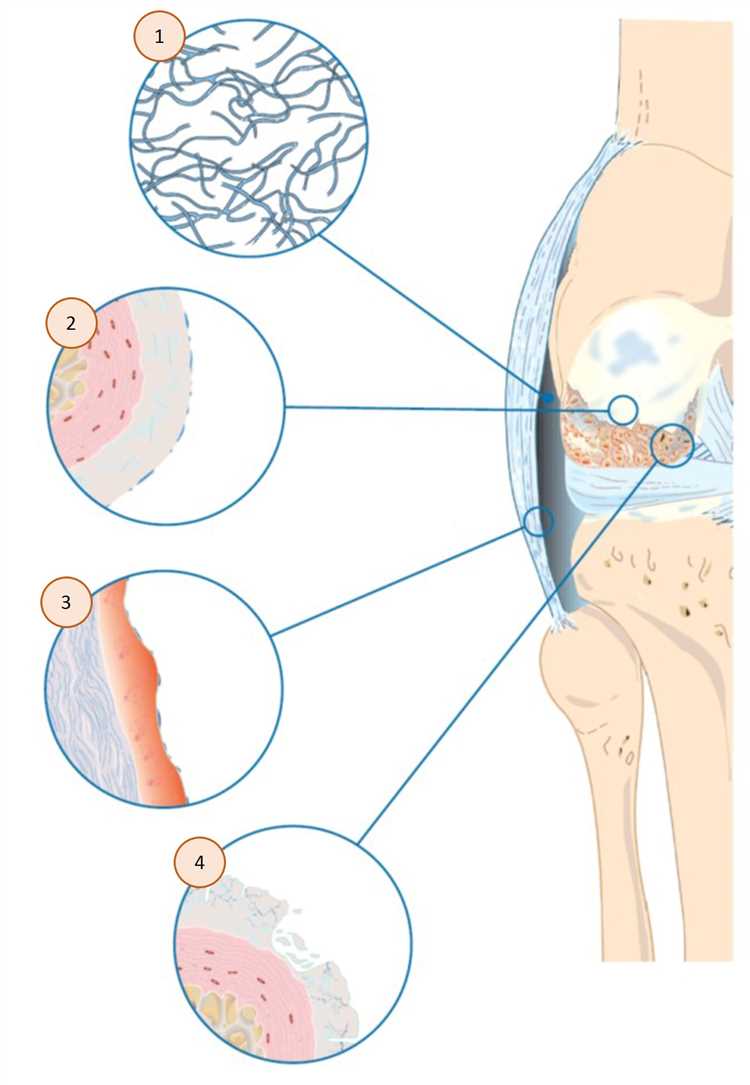 Osteoartrit İçin Hiyalüronik Asit