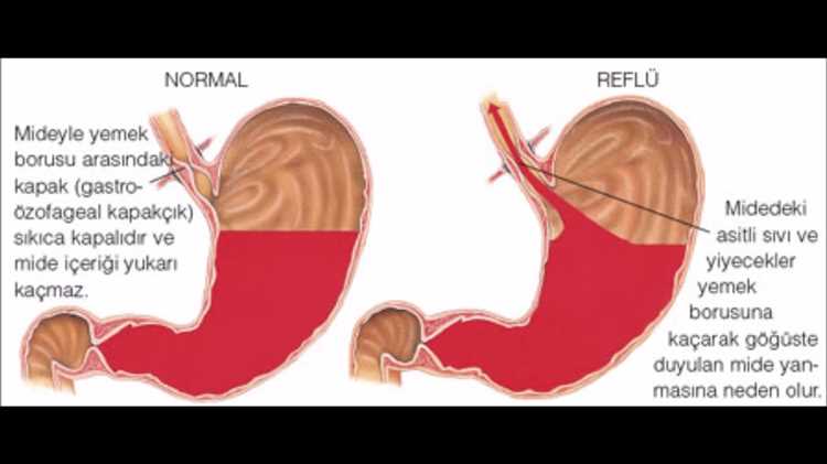 Reflü hastalığı hakkında bilmeniz gerekenler