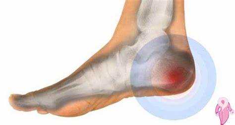 Topuk ağrısı uyandıktan sonra yürürken ortaya çıkan yaygın bir rahatsızlıktır. Genellikle topuğun arkasında, golenin alt kısmında hissedilen bu ağrı, yürüme sırasında artar ve zamanla şiddetlenebilir. Bu durum, tıp dilinde 